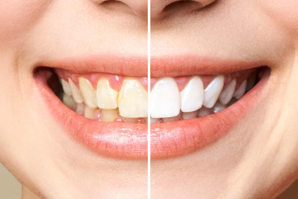 Clareamento Dental em Guarulhos Clareamento Dental em Guarulhos